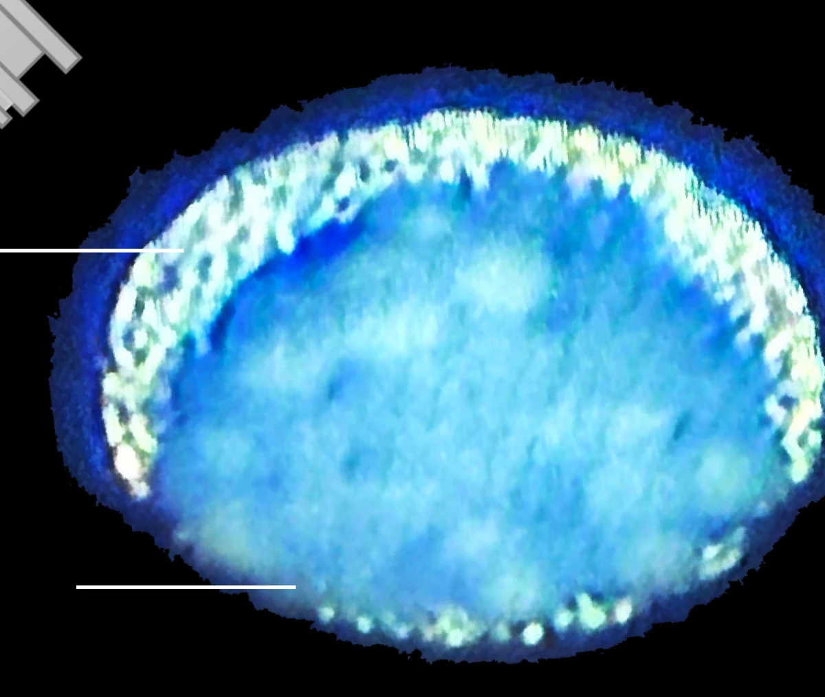 Scanning electron micrograph of an occluded needle hub